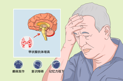 桥本脑病