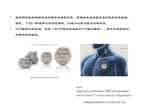 精品课件 vns治疗儿童难治性癫痫的若干进展 西交二院吕健 巩守平等