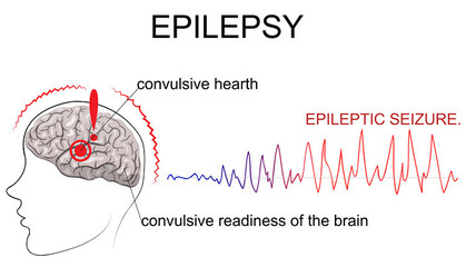 癫痫 一场难以挣脱的清醒噩梦