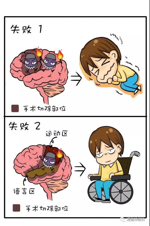 癫痫手术成功的关键 精准评估、精确定位与综合管理